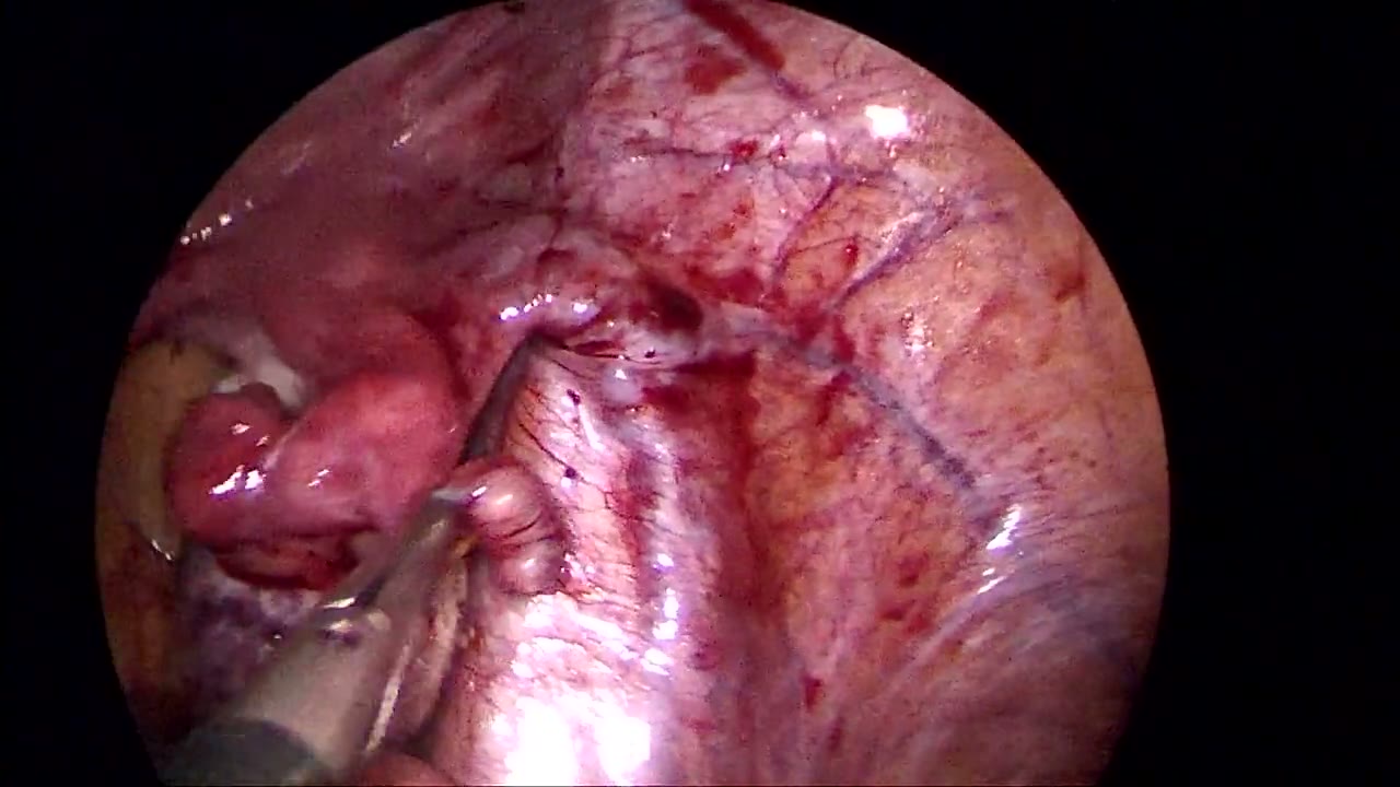 Quiste endometriosico